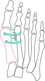 拇指外翻/拇趾外翻/Bunion stabilize-surgical-technique