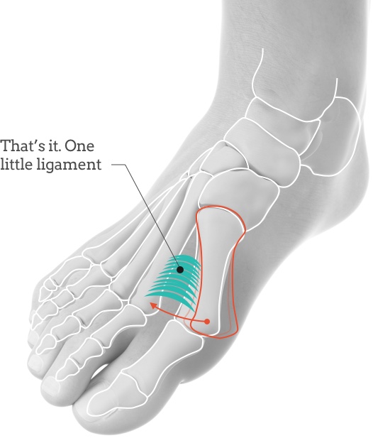 拇指外翻/拇趾外翻/Bunion little ligament